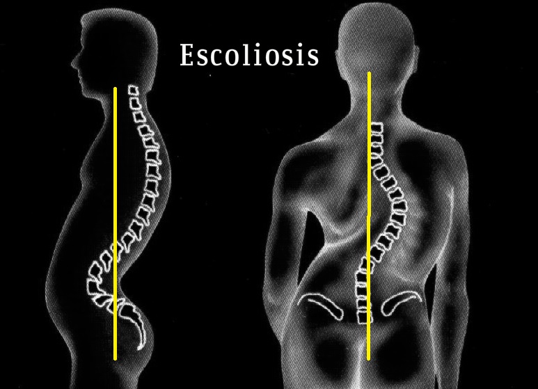 Patologías - Columna vertebral - escoliosis - Tratamiento con Pilates - Fernanda Millions Dutra - Pilates Sant Celoni - Curvatura columna